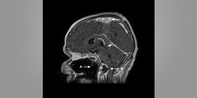 An MRI on his second visit, during which he was hospitalized with a suspected overdose, showed several brain issues in addition to the hole in this throat that was observed on his first visit.