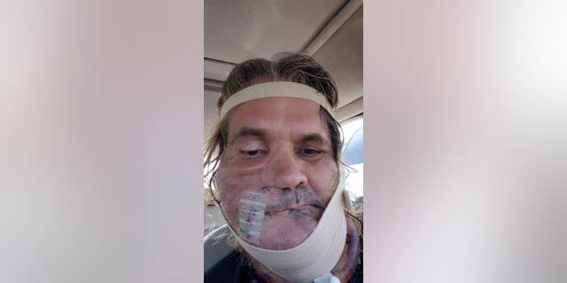 Eddy has undergone more than 30 major surgeries and more than 50 minor ones to control the growth of tumors.