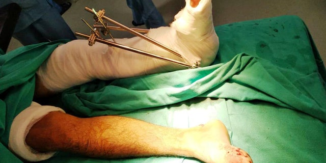 "Since the bones of Karan's left foot were completely crushed, we had to shorten the limb a bit before stitching it back," a doctor said.