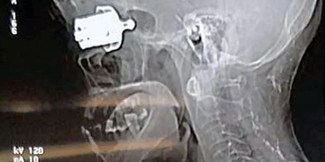 A scan shows the whistle lodged into the woman's skull.