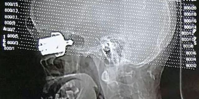 Only a CT scan could show how deeply the object had jammed near her brain. (SWNS)