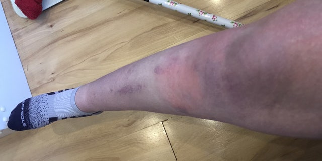 Helena Stone's leg as it suffered from complex regional pain syndrome (CRPS). (SWNS)