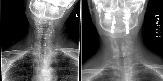 These X-rays show Bobeczko's crooked posture on the left, and the result of Lee's radical approach which involved re-breaking her neck and separating her skull from the rest of her body to realign it to the original position.