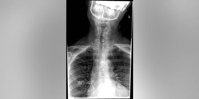 Several weeks after a surgeon placed a screw meant to fix her fracture, she developed a cock robin posture and was in excruciating pain.