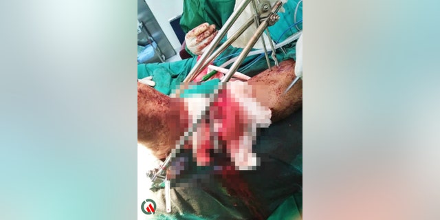 The surgery to reattach the man's foot took seven hours, doctors said.