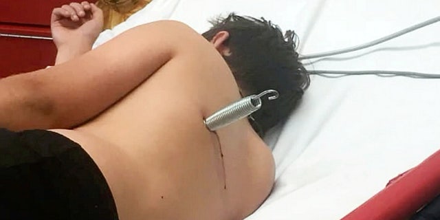 A boy narrowly avoided life-threatening injuries after a freak trampoline accident saw a spring enter his back like a bullet.