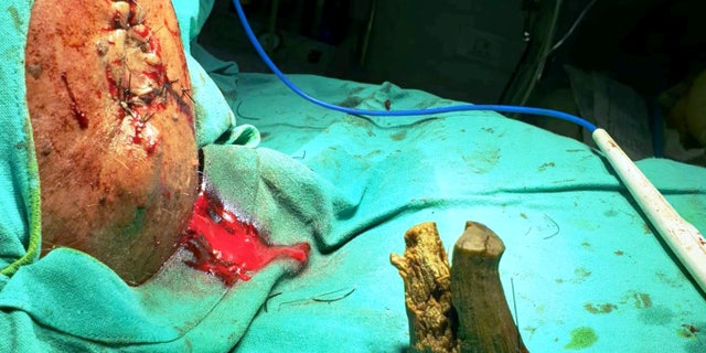 He finally sought help five years after the initial injury.