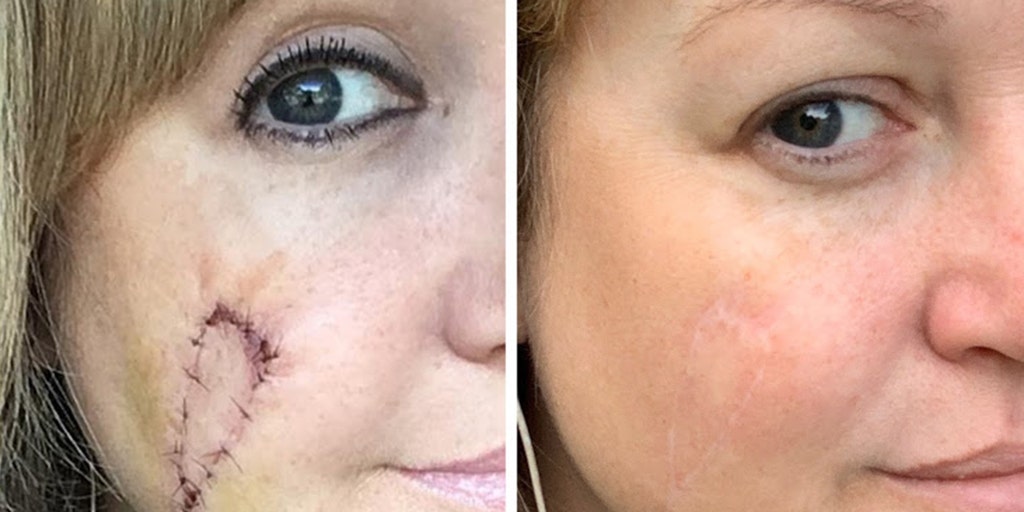 Woman left with 'hole' in face from melanoma regrets 'better to be