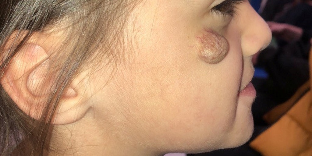 Girl, 4, bullied for birthmark on face hopes to have 'lump' removed; people  'point and laugh,' mom says