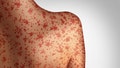 Measles concept as a deadly outbreak immunize,disease and viral illness as a contagious chickenpox or a skin rash in a 3D illustration style. (Photo: iStock)