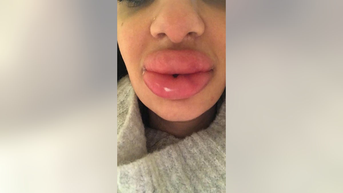 But after noticing a lumpy unevenness, she went back to the place she had them done and they added even more filler to "even them out," which caused even more damage and made her lips turn "rock hard." 