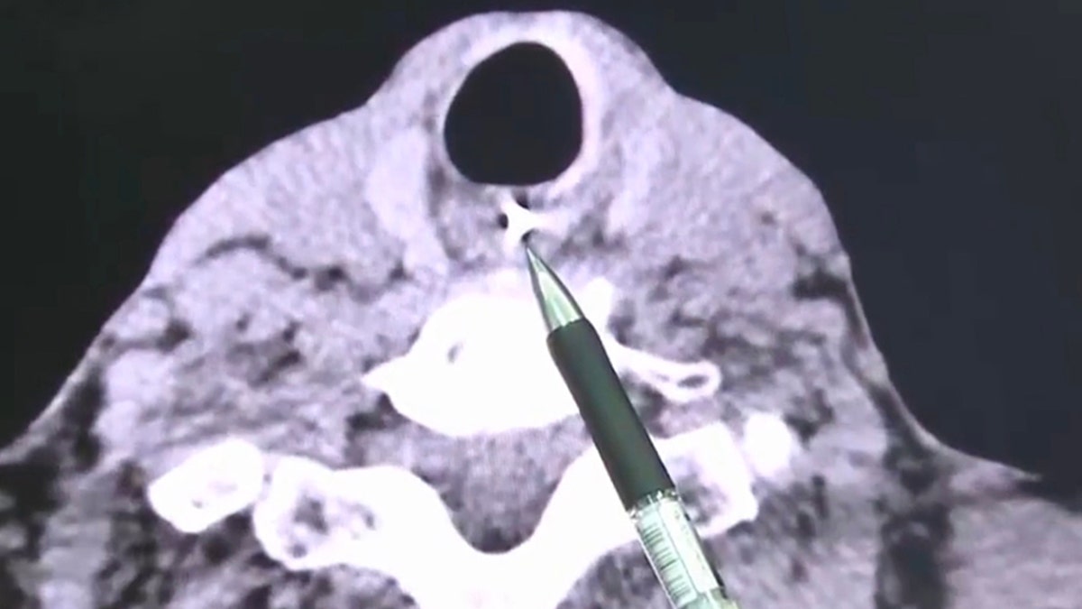 A scan revealed the dentures had lodged into his esophagus, meaning they would have to open his throat to remove it.