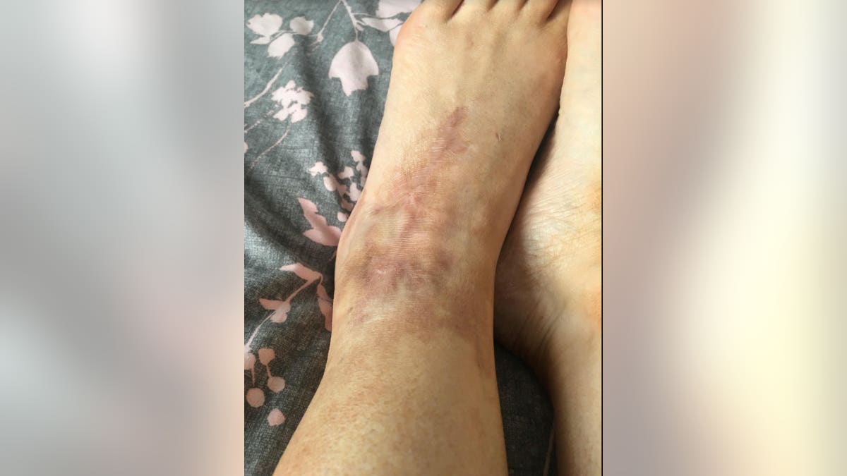 A more recent photo of her affected foot.