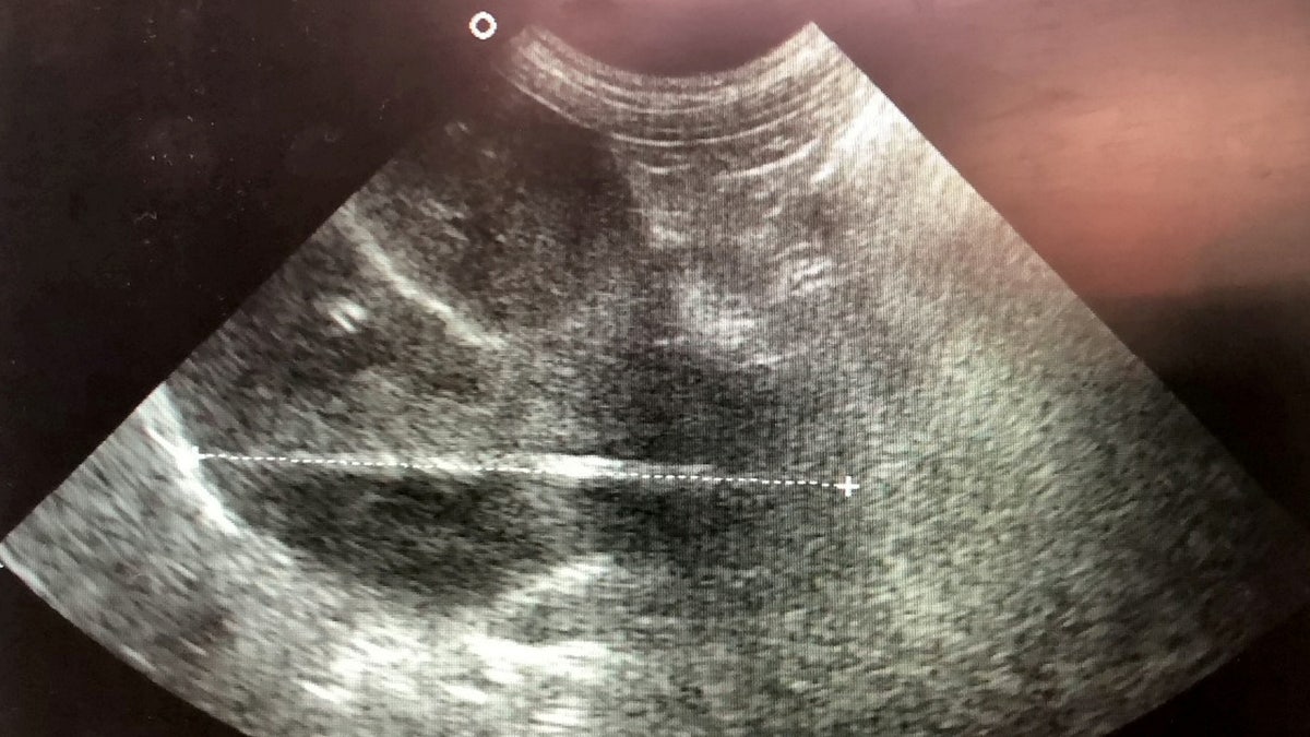 The skewer can be seen in an ultrasound image.
