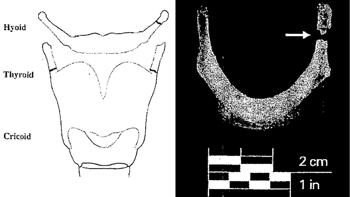 A diagram from Jeffrey Epstein's autopsy report summary showing the approximate location of a fracture on his hyoid bone. (New York City Medical Examiner's Office)