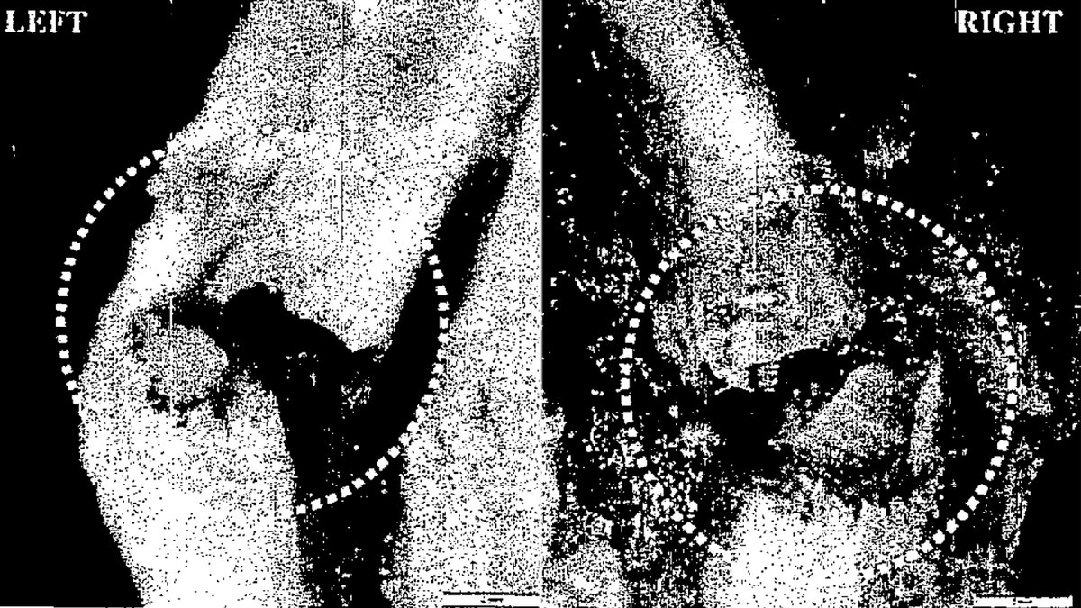 A microscopic view of two fractures (circled) on the let and right sides of Jeffrey Epstein's thyroid. (New York City Medical Examiner's Office)