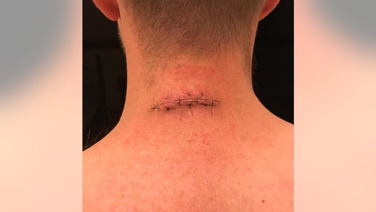 Ryan's neck after one of his initial surgeries.