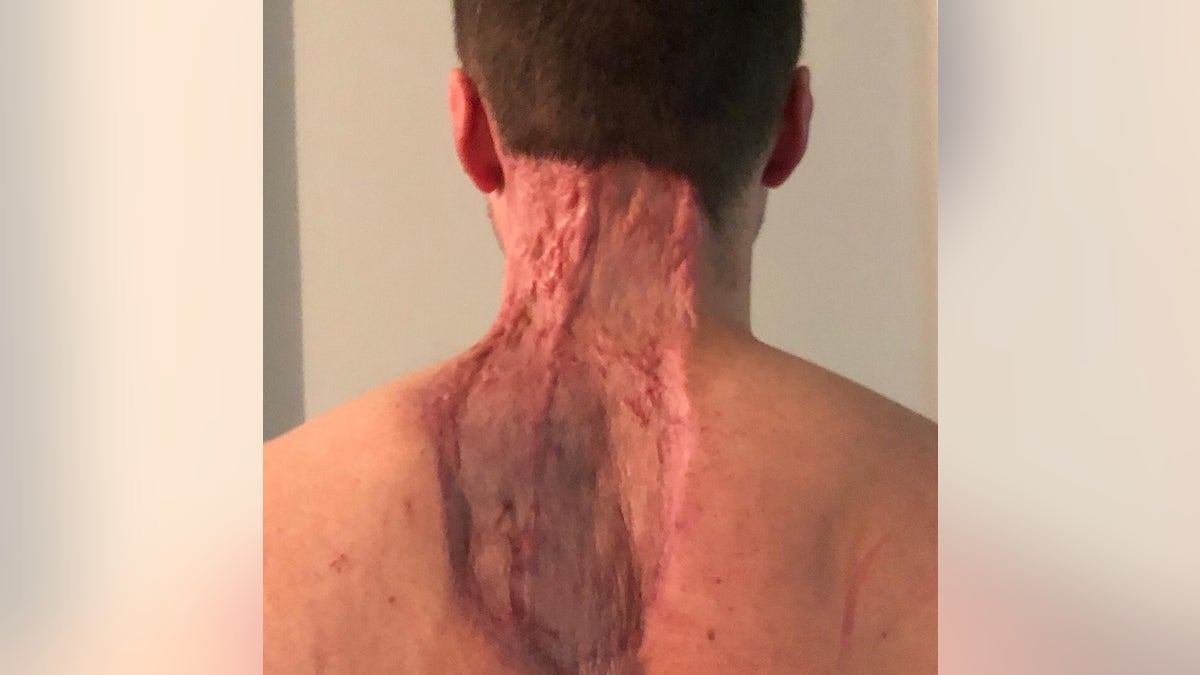 A large area of skin was removed from Ryan's back and neck.