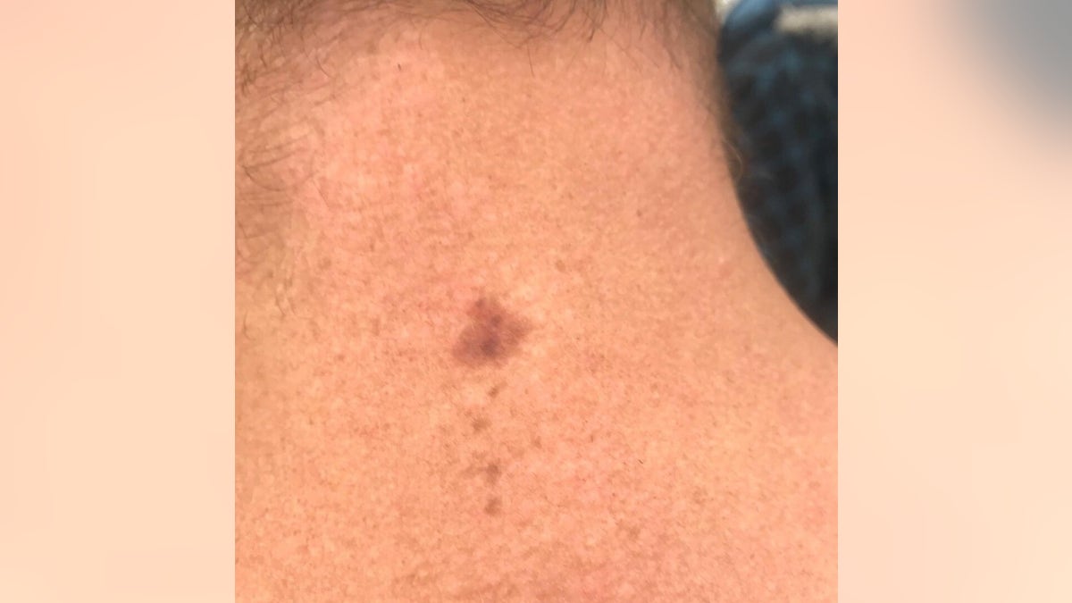 The spot on the back of Ryan's neck that was later determined to be cancerous.