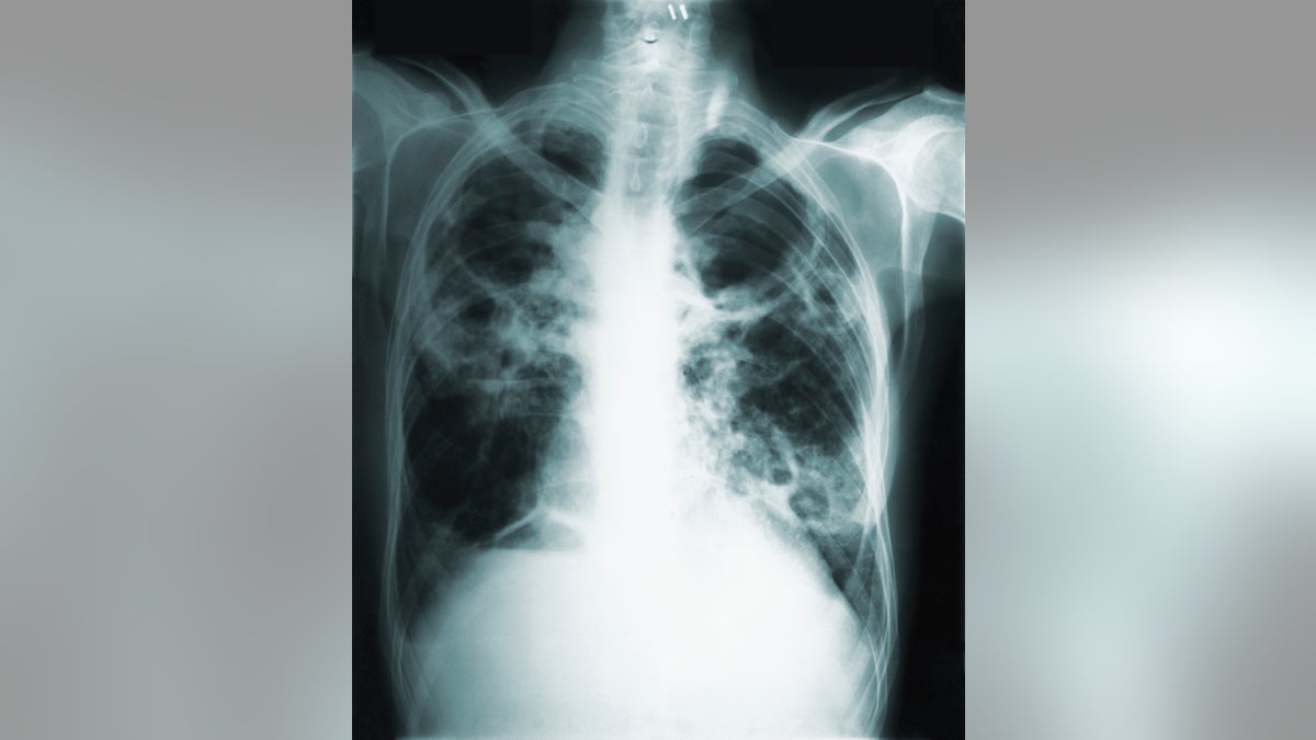 This 1966 image made available by the Centers of Disease Control and Prevention shows a chest x-ray of a tuberculosis patient.?