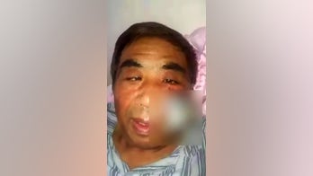 Man's face rotted from infected mosquito bite: report