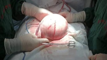 'Pregnant' woman has 6-inch, 3-pound mass removed from uterus