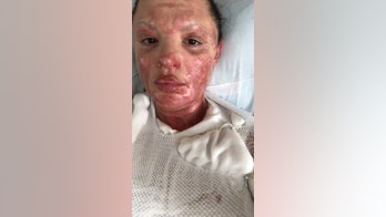 Mom horribly burned in gas grill accident says recovery has taught her 'patience'