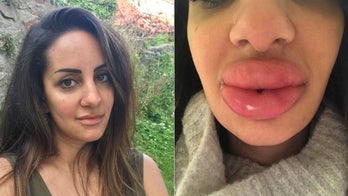 Dentist left with swollen 'lumps' in lips after seeking cheap fillers