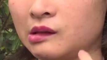 Woman claims botched nose, chin surgery left her with crooked mouth, drooling issues