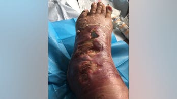 Woman contracts flesh-eating bacteria after insect bite, nearly loses foot: 'I felt like I had been stabbed'