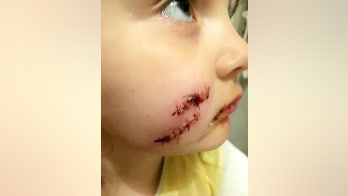 Girl, 5, receives 36 stitches after dog 'ripped off' her face, mom claims