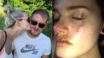 Woman's face burned after 'romantic' candle ignites pillow fire