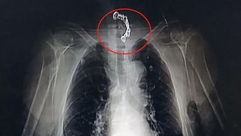 Man nearly chokes to death on dentures after accidentally swallowing them during meal