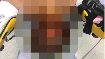 Rare condition causes man’s testicles to swell to 7 pounds: case report