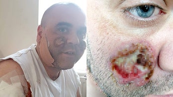 Man's rare skin condition causes pus-filled ulcers on face, body: 'I look like a zombie'
