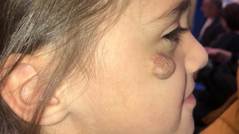 Girl, 4, bullied for birthmark on face hopes to have 'lump' removed; people 'point and laugh,' mom says
