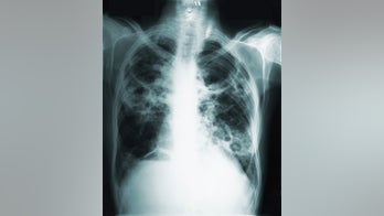 Vaccine shows promise for preventing active TB disease