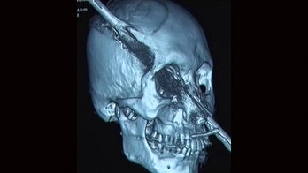 Man impaled through nostril, skull after falling 15 feet onto steel rod, report says