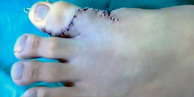 His surgeon said rather than simply removing the extra toes, he wanted to create a typical-looking big toe for him.