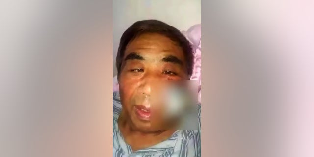 Mr. Hu's cheek was surgically removed after he scratched a mosquito bite caused his face to become infected and necrotic.