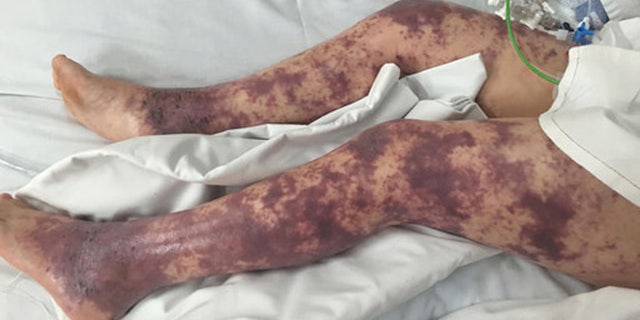 The horrible rash that took over Brogans legs.