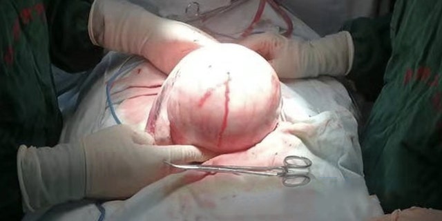 The woman had experienced heavy bleeding and weight gain over the last several months.