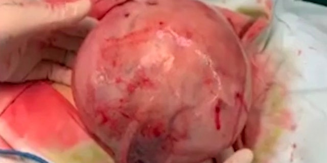 She said her friends assumed she was pregnant, but it wasn't until she started experiencing dizziness that she sought medical attention.