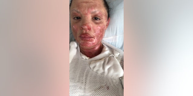 Her recovery is expected to take between nine and 12 months.