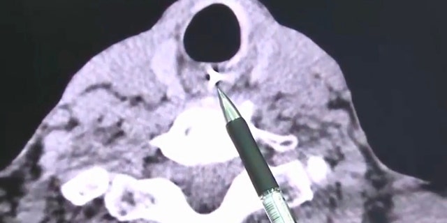 A scan revealed the dentures had lodged into his esophagus, meaning they would have to open his throat to remove it.