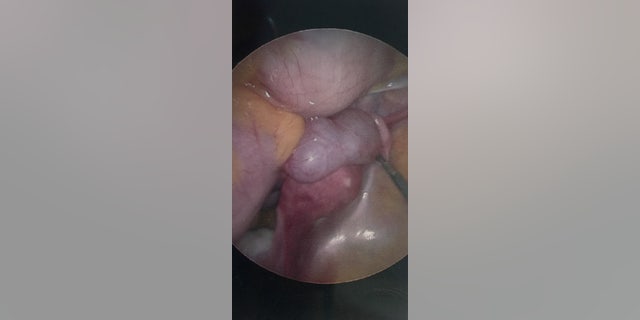 Callie Haye's swollen fallopian tube.