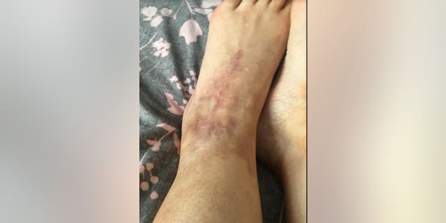 A more recent photo of her affected foot.