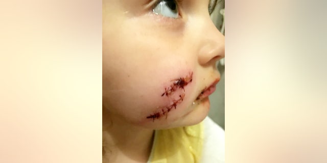 Molly Beresford, 5, was reportedly bitten by a dog after tagging along with her mother to the home of a woman selling furniture.