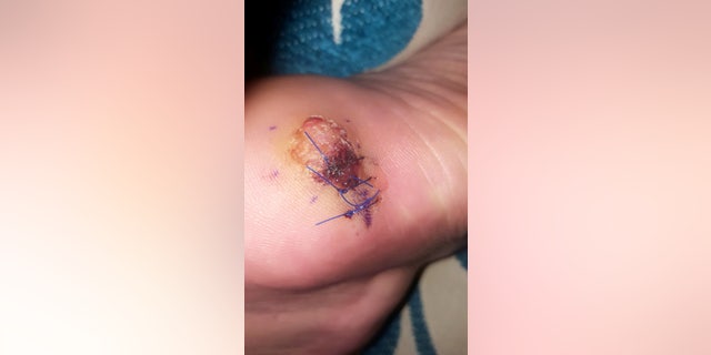 Once she was diagnosed they removed all the cancer from her foot, but it eventually returned in her groin, stomach and lungs.