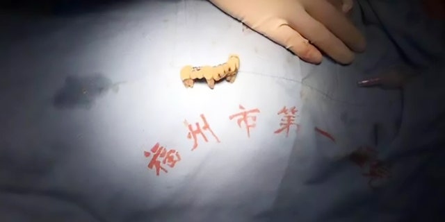 The dentures had to be removed in an four-hour surgery.